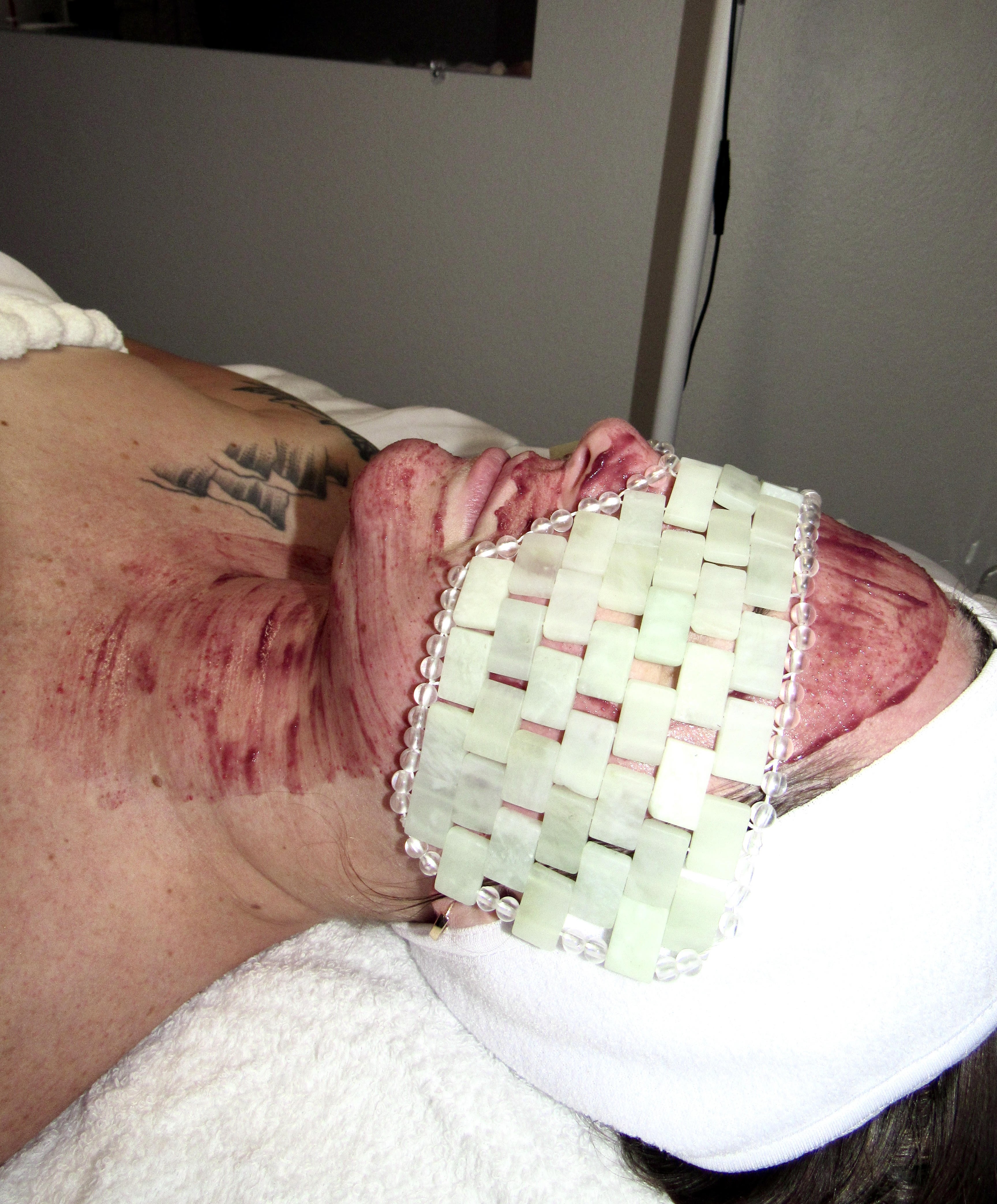Acne and hyperpigmentation facial treatment